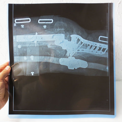 Vintage Genuine Medical X-Ray 14X14" of a Broken Limb Knee with Multiple Medical Surgical Plates, Screws and Straps, Human Skeleton